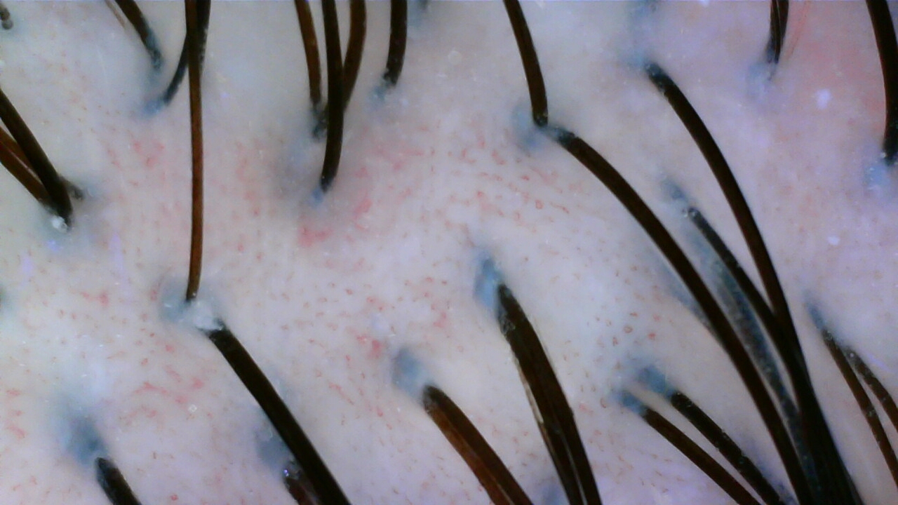 Scalp camera image after care, case two