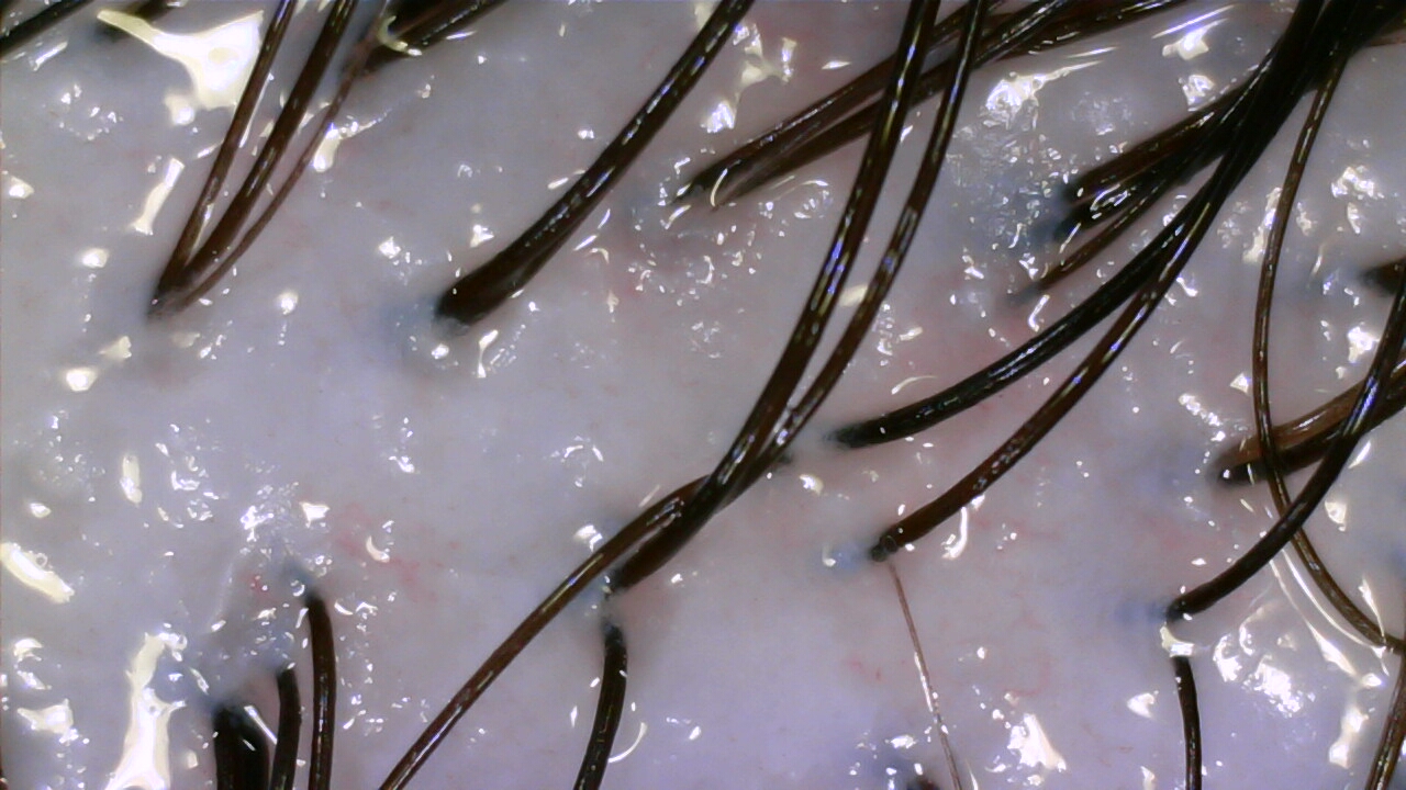 Scalp camera image after care, case three