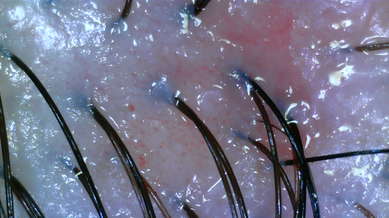 Scalp camera image after care, case four