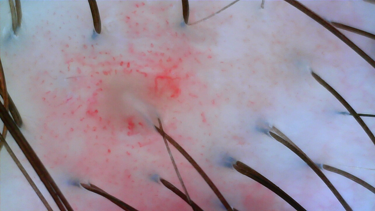 Scalp camera image after care, case one