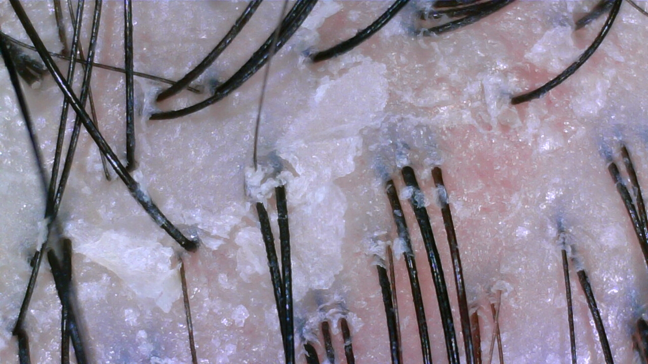 Scalp camera image before care, case two