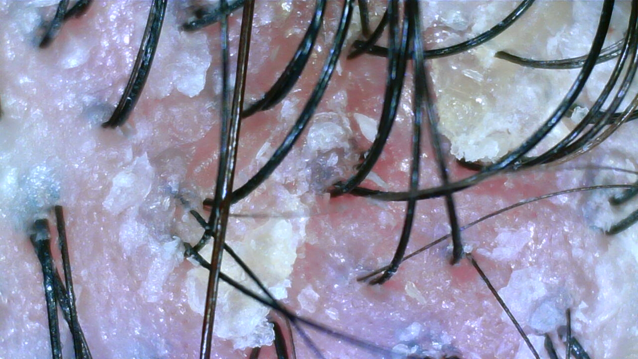 Scalp camera image before care, case three