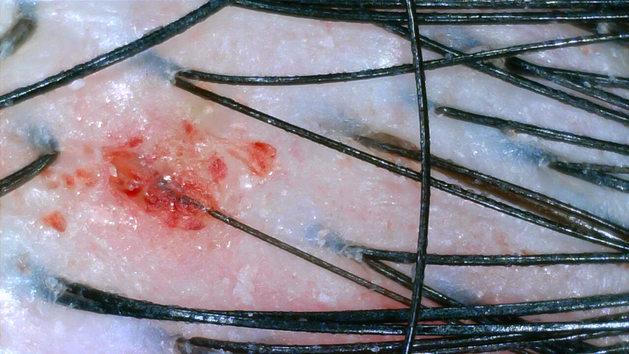 Scalp camera image before care, case four