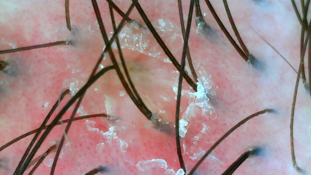 Scalp camera image before care, case one